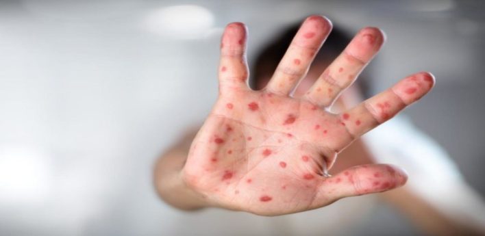 Кір, висип, рука, дитина