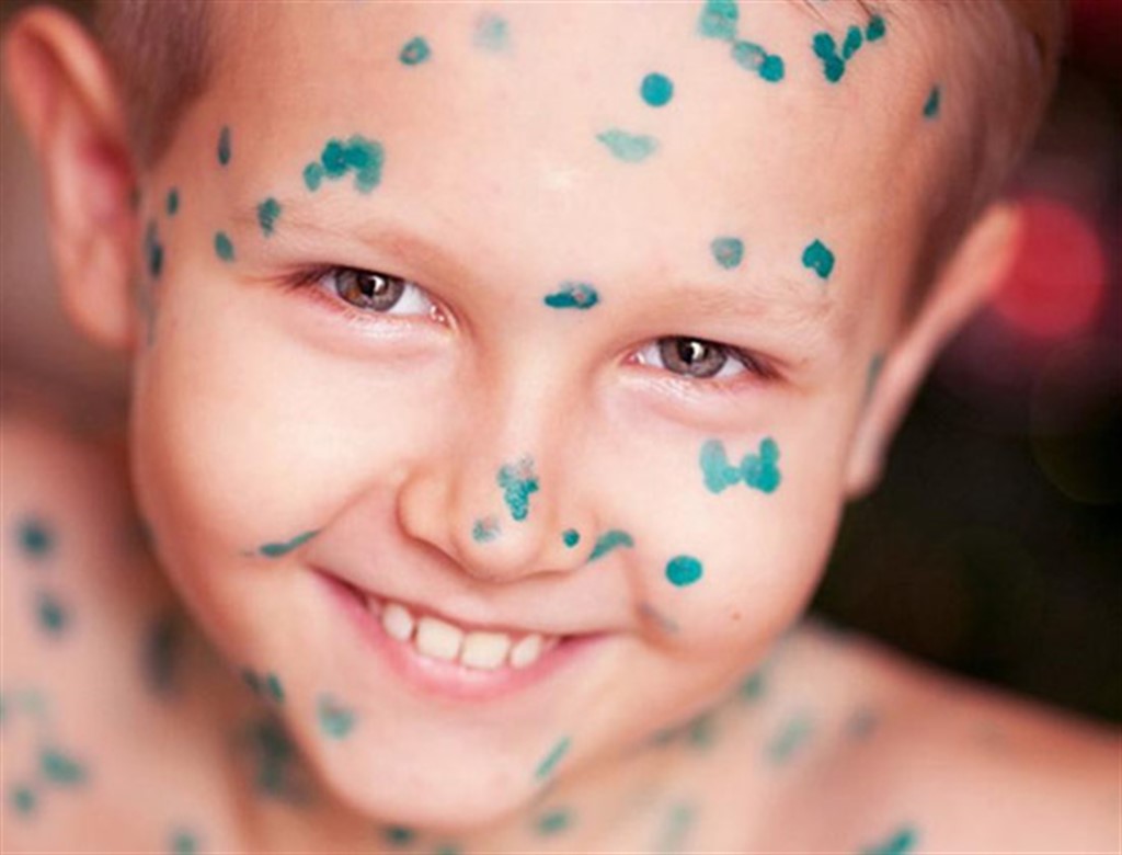 Вітрянка б’є рекорди: 19 випадків за тиждень, 5 із них – у садочку «Червоні вітрила»