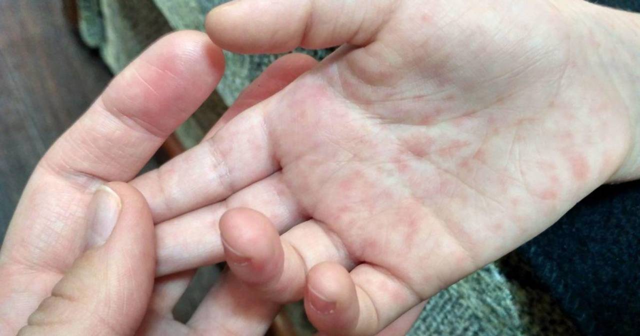 Число хворих на кір збільшується, медики б’ють на сполох