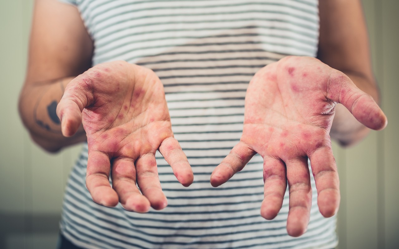 641 діагноз кору за 5 місяців і параліч дівчинки як факт небезпеки