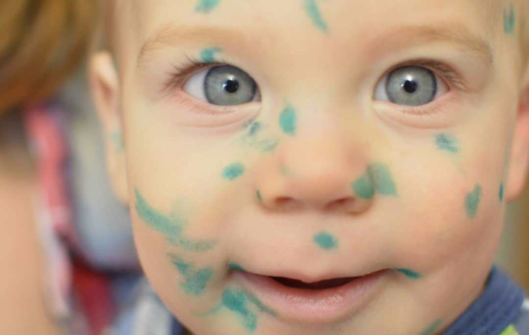 Спалах вітрянки в садочку «Джерельце»: 12 хворих дітей лише за тиждень